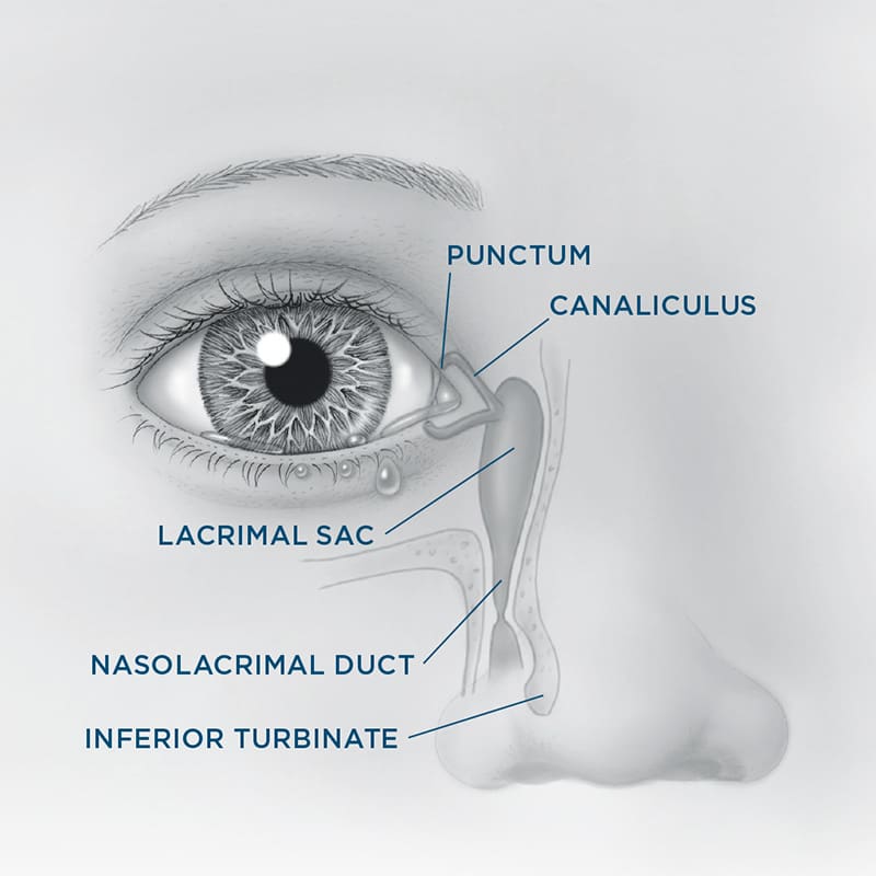 Blocked Tear Ducts Kids Probing Tubes