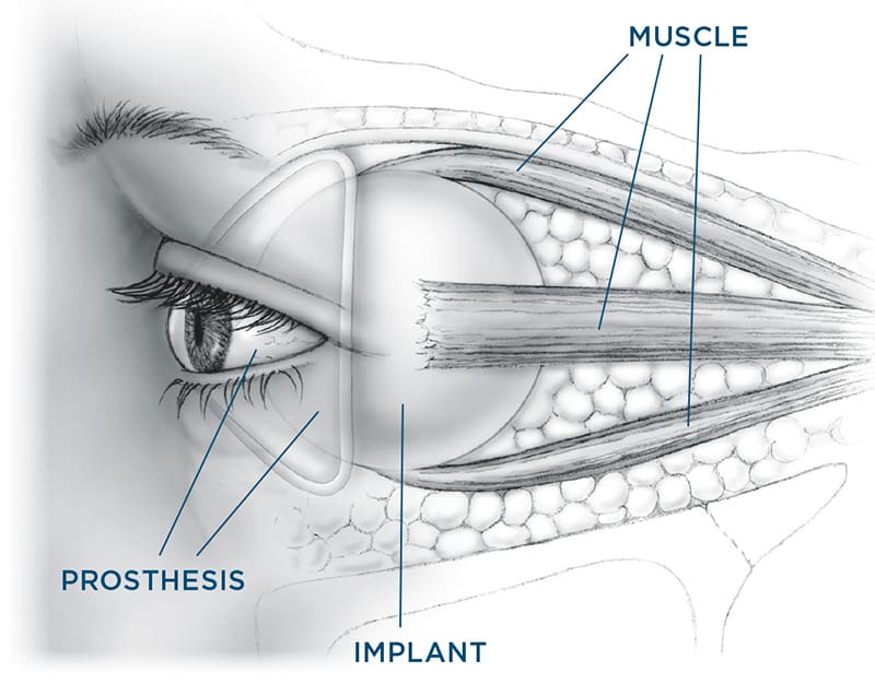 Eye Removal Enucleation Evisceration