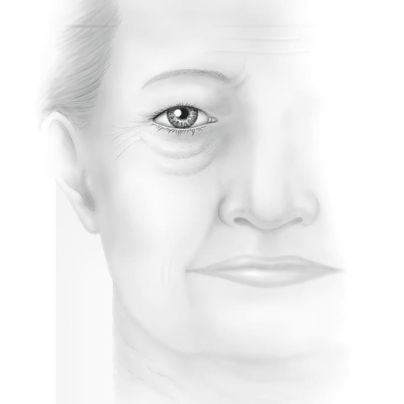 Facelift and Neck Lift