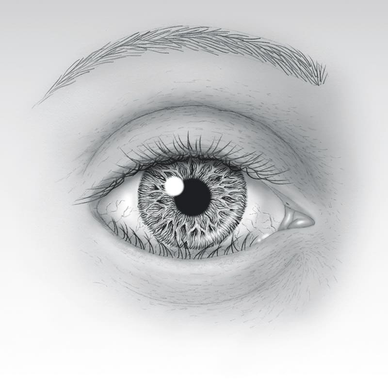 Turned-In Eyelid (Entropion)